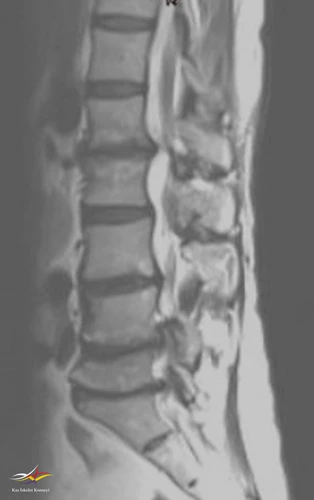 Lomber MRG, T2 ağırlıklı sekans, sagittal plan.