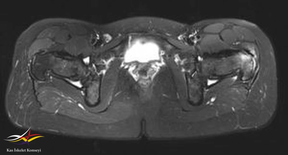 Aksiyal T2 ağırlıklı MRG incelemesi.