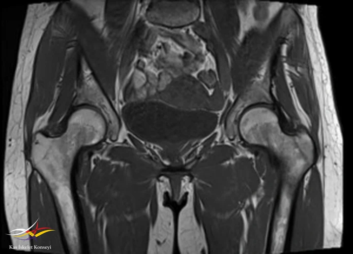 Koronal T1 ağırlıklı MRG incelemesi.