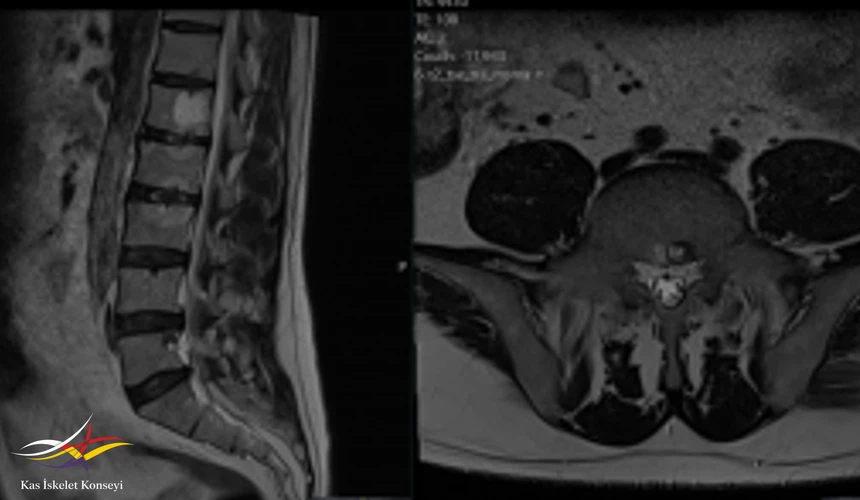 L1 vertebra korpusunda yaklaşık 22 mm çapında T1 ve T2 ağırlıklı sekanslarda hiperintens hemanjiom ile uyumlu nodüler lezyon izlenmektedir. L1-L2 ve L2-L3 vertebralar korpus end platoları düzeyinde T1A sekanslarda heterojen izohipointens, T2 ağırlıklı sekanslarda hiperintens sinyal değişiklikleri izlenmekte olup bu seviyelerde intervertebral disk sinyal intensitesinde T2 ağırlıklı sekanslarda artmıştır. Bulgular ilk planda inflamatuar spondilodiskit lehine değerlendirilmiştir (Andersson lezyonu). L5 vertebra korpus orta kesim posteriorsuperior alanda üçgen şekilli T1 sekanslarda hipointens T2A sekanslarda hiperintens sinyal değişikliği izlenmiş olup önceki tetkike göre azalmıştır. L2 vertebra üst endplate sol anterolatralde T2 AS hiperintens, T1 sekanslarda hipointens sinyal değişikliği izlenmiş olup önceki tetkike göre yeni gelişimlidir (Aktif Romanus lezyonu?).
