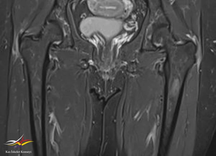 Kalça MRG koronal kesit, solda hakim iki yanlı trokanterik bursit ile uyumlu.