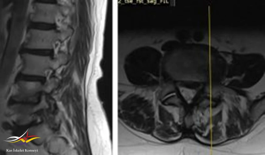 Lomber MRG, L4-5 seviyesi sol paramedian kesit foramen stenozunu göstermekte.