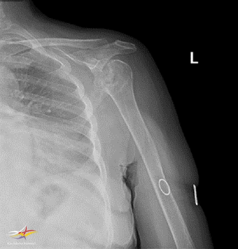 Sol omuz direkt grafi-1.