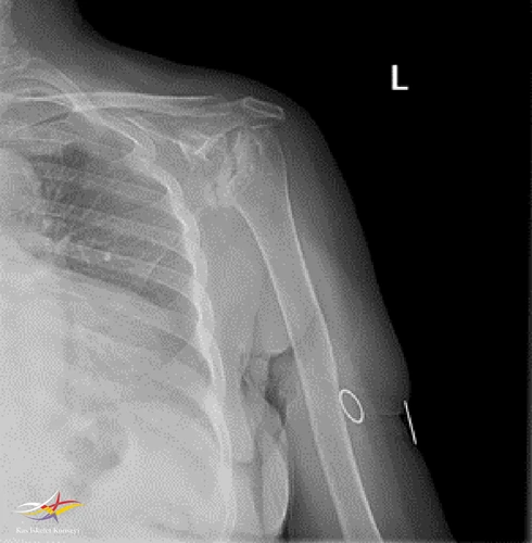 Sol omuz direkt grafi-2.