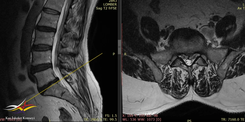 Lomber MRG'de L5-S1 disk hernisi görülmekte. Sol iliak ve korpus ön komşuluğunda dilate görünümde.