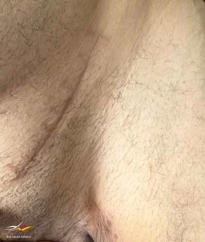 Sol kasık bölgesi komşuluğunda ameliyat skarı görülmekte.