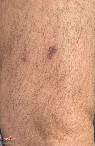 Sol uyluk ön yüzde kabuklanmış cilt döküntüleri (zona?).