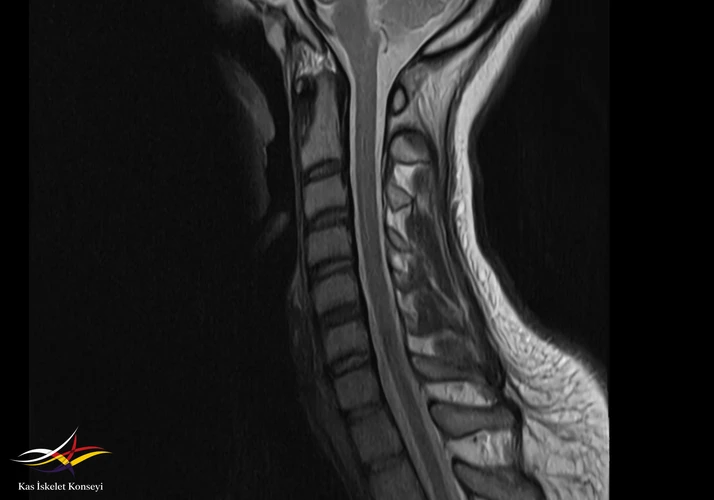 Servikal MRG: Normal.
