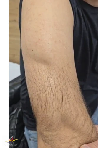 Triceps görünümü.