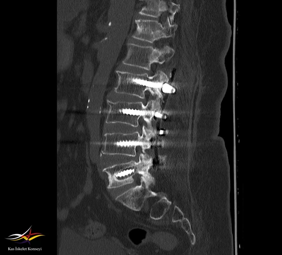 BT tetkikinde L5 pedikül vidalarında gevşeme bulguları (halo) saptanmıştır.