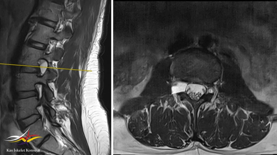Sagittal ve aksiyal T2 ağırlıklı inceleme.