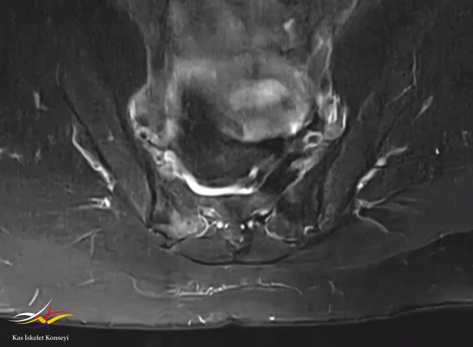 Sakroiliak MRG aksiyal kesitte sakrum sağında belirgin hiperintens alan.