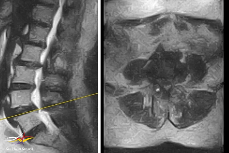 2029 yılına ait suboptimal MRG de L4-5 listezis ve dar kanal görülmekte.