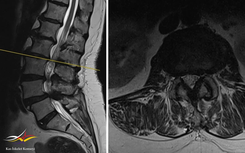Lomber MRG'de L2-3 seviyesinde ılımlı bir darlık görülmekte.
