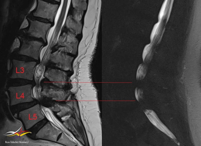 Sagitaal MRG ve MRG myelografide darlık seviyeleri.