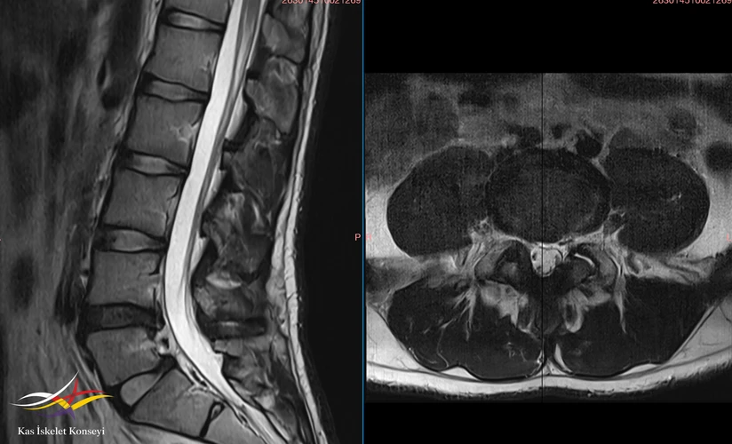 L4-L5 seviyesinde intervertebral diskin T2 ağırlıklı serilerde sinyal kaybı (dehidratasyon) gösterdiği ve buna eşlik eden disk patolojisi (diskopati) net bir şekilde izlenmektedir. Sagital kesitte L4-L5 intervertebral disk aralığında daralma, posteriora doğru taşma (herniasyon) ve dural kese anterioruna bası dikkat çekmektedir. Aksiyel kesitte ise bu diskopatinin spinal kanalı daralttığı ve dural keseyi belirgin şekilde indentasyona uğrattığı ayırt edilebilmektedir.