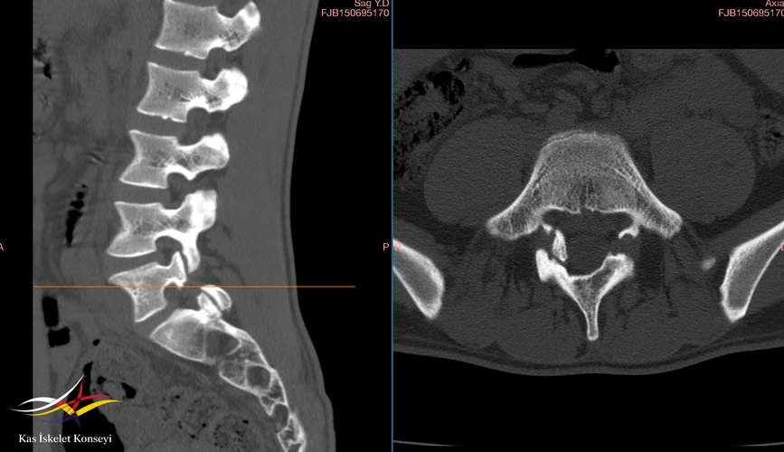 L5-S1 seviyesinde bilateral pars interarticularis defekti (spondilolizis) net bir şekilde izlenmektedir. Sagital rekonstruksiyonda laminanın pedikül ile birleştiği istmik bölgedeki kemik devamlılığın kesintiye uğradığı (lizis hattı) açıkça ayırt edilmekte olup, aksiyel kesitte ise bu defektin faset eklem morfolojisi ve arka eleman bütünlüğü üzerindeki anatomik yansımaları görülmektedir. Mevcut radyolojik bulgular, instabiliteye zemin hazırlayabilecek ve özellikle ekstansiyonla artan mekanik bel ağrısı etiyolojisinde rol oynayan izole bir pars defektini (spondilolizis) stabilize ve net bir şekilde ortaya koymaktadır.