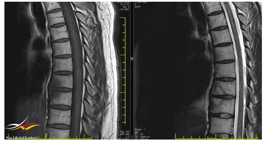 Kontrastlı Torakal MR T1- T2 sagittal