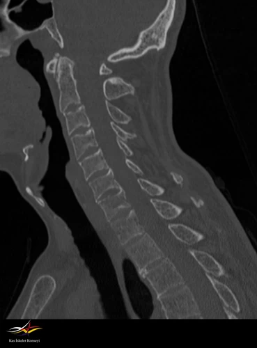 Servikal BT-Sagittal orta hat.