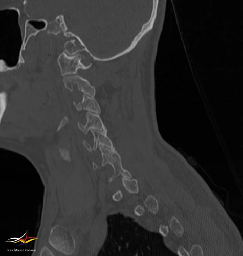 Servikal BT-Sagittal paramedian-Yaygın faset füzyonları görünmekte..