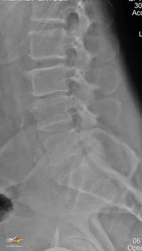 Lomber LATERAL