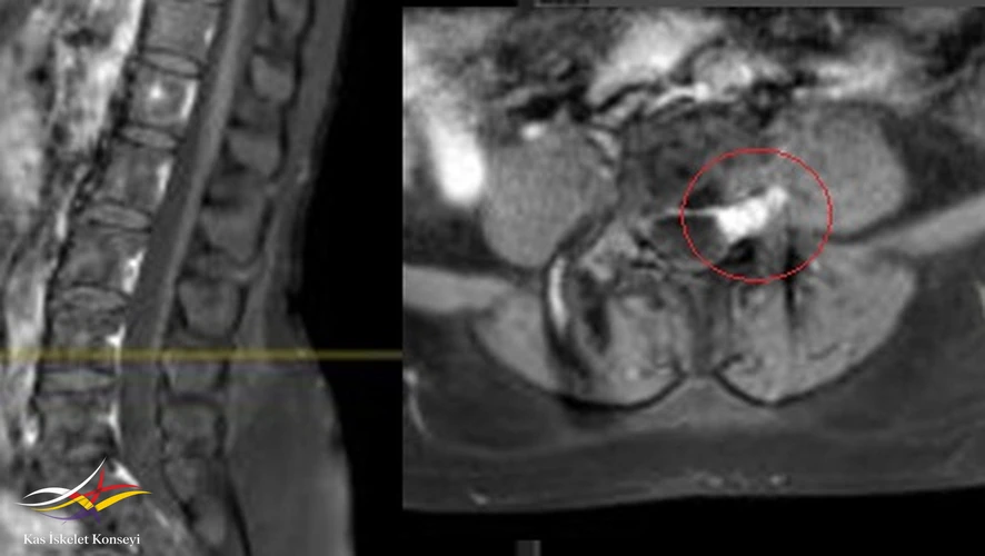 Kontrastlı MRG'de lezyonun yoğun kontrast tuttuğu görülmekte.