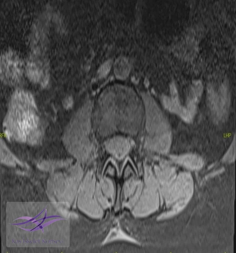 Aksiyel T2 ağırlıklı MR görüntülerinde lezyon paraspinal kas düzlemlerinden net bir şekilde ayrılarak deri altı doku ile fasyal tabaka arasında iyi sınırlı bir sıvı sinyal alanı mevcut.