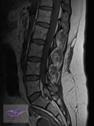 Sagital T1 ve T2 ağırlıklı lomber MR görüntülerinde subkutan doku ile torakolomber fasiyal planlar arasında psödokapsüllü sıvı toplanması izlenmekte (Morel-Lavallée lezyonu).