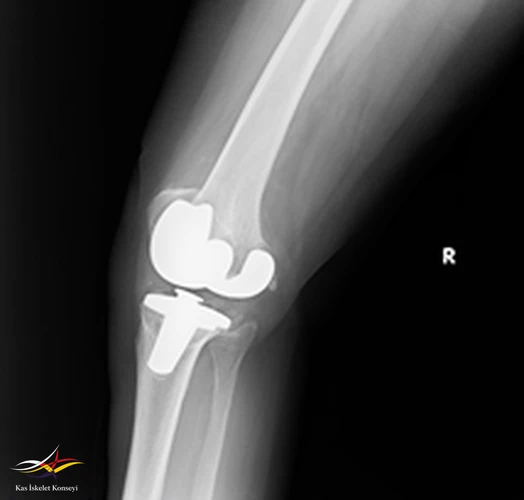 Revizyon ameliyatı öncesi lateral direkt grafi.