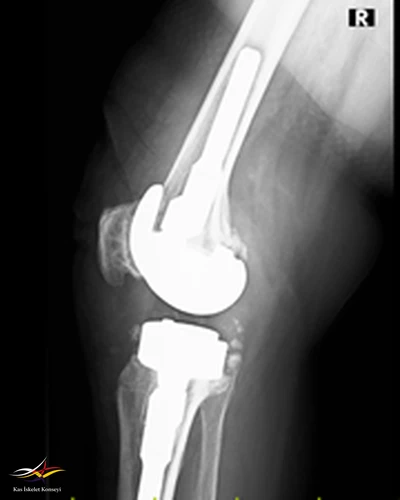 Revizyon ameliyatı sonrası lateral direkt grafi.