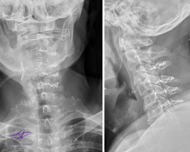 Postop grafide C3-C6 seviyelerinde laminoplasti plakları görülmekte.