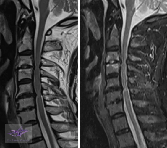 Preop MRG incelemelerinde servikal dar kanal ve omurilikte myelopatik değişiklikler görülmekte.