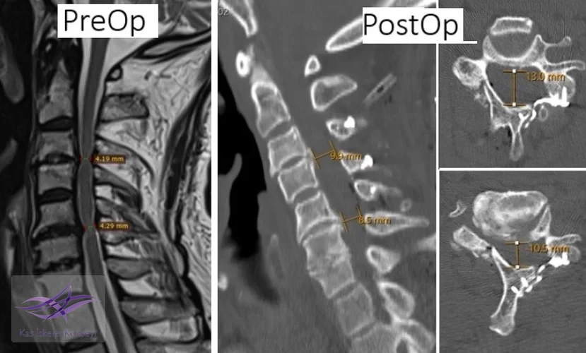 Preop ve postop incelemelerde kanal çapındaki artış görülmekte.