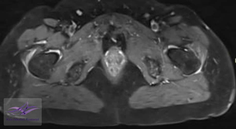 Kalça MRG, aksiyal kesit.