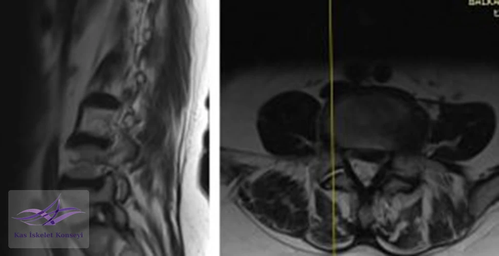 Lomber MRG, L4-5 seviyesi sağ paramedian kesit.